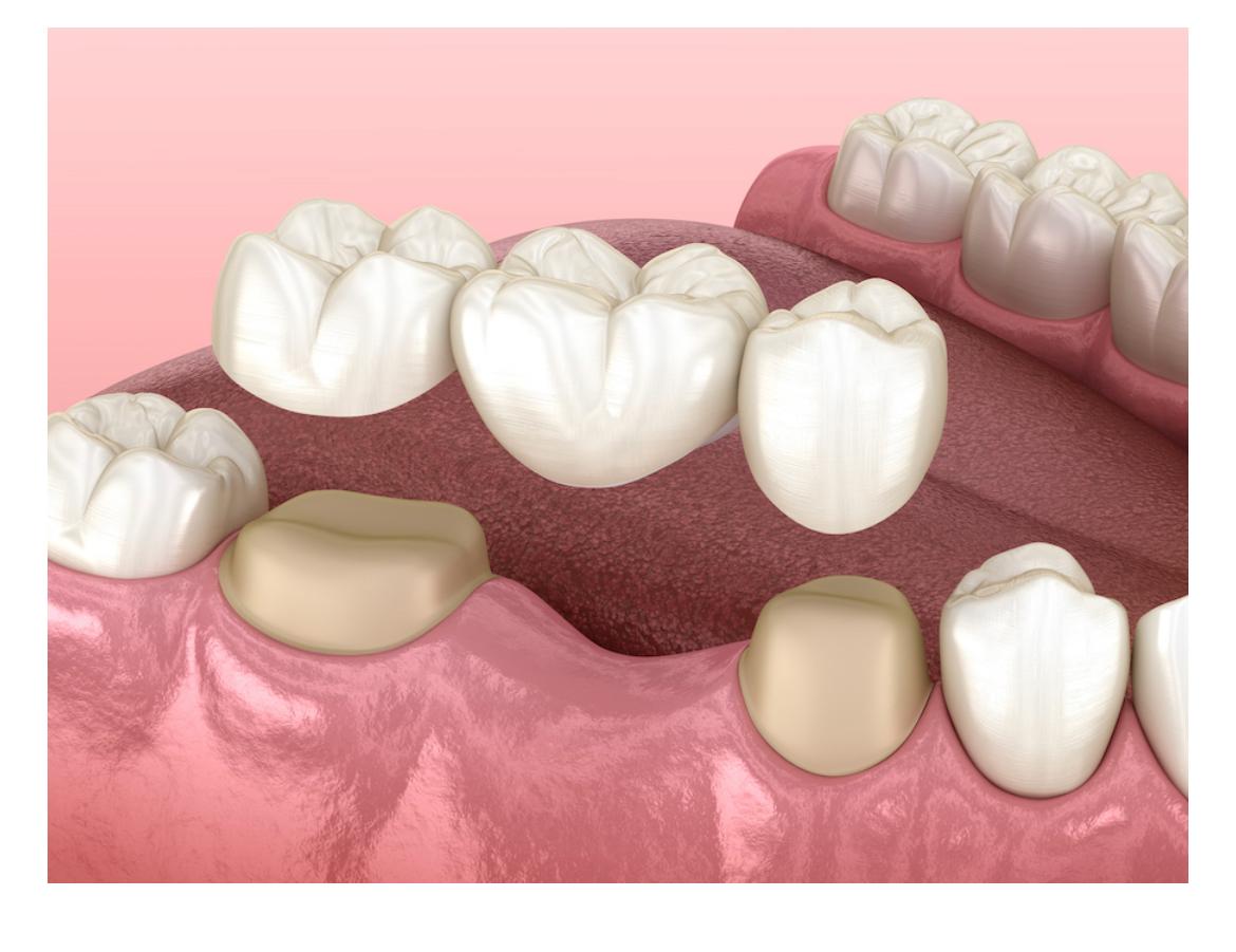 Dental crown and bridge work