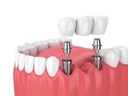 Cosmetic dental veneers