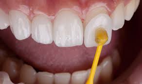 Root canal treatment