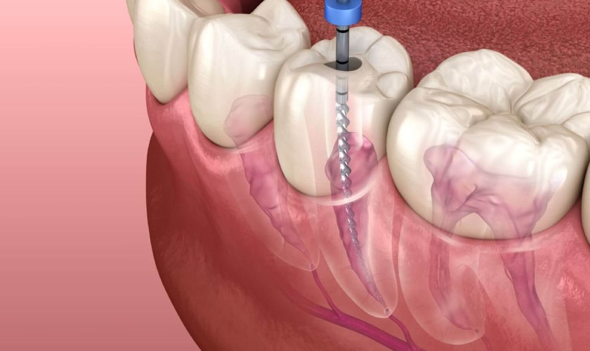 Root canal treatment